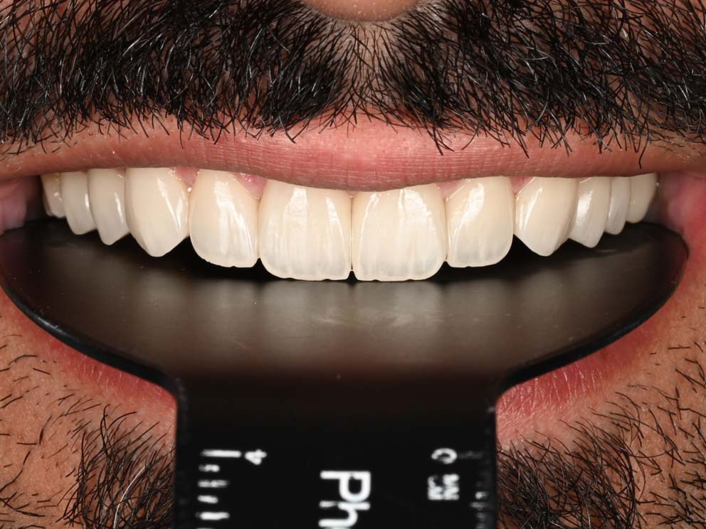 Complete Veneer Transformation Package 3