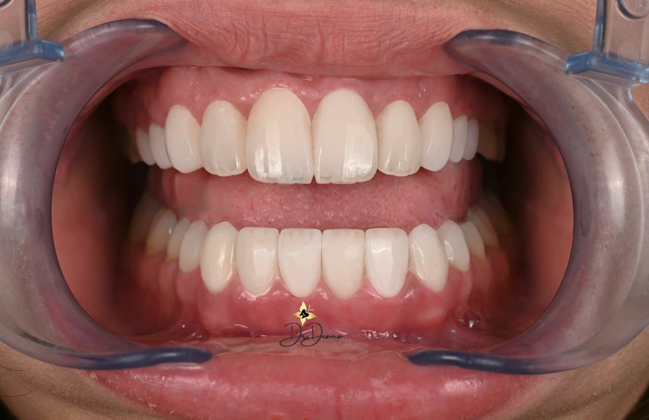 Complete Veneer Transformation Package 4