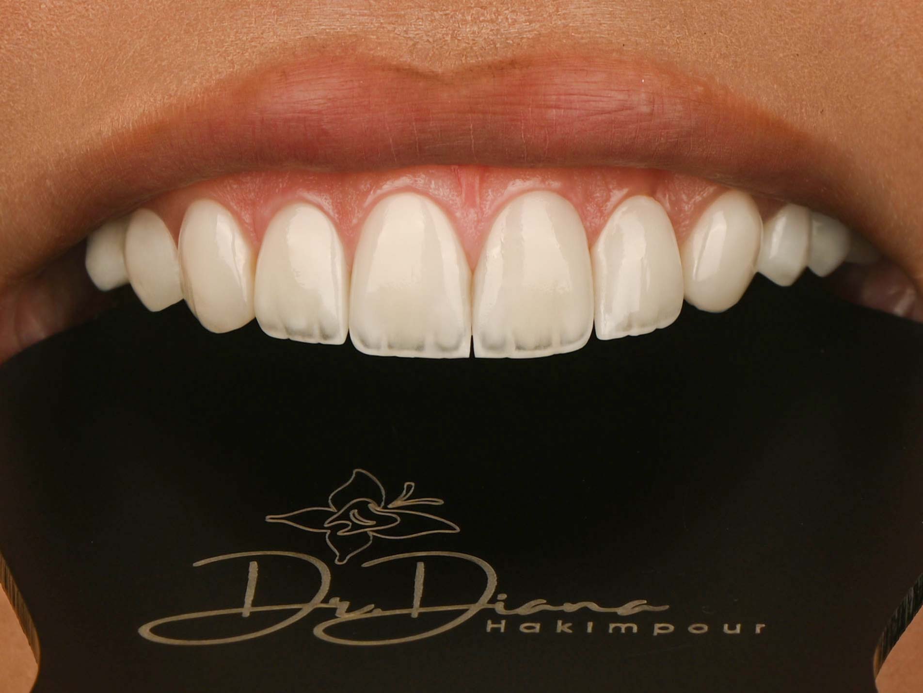 Complete Veneer Transformation Package 5