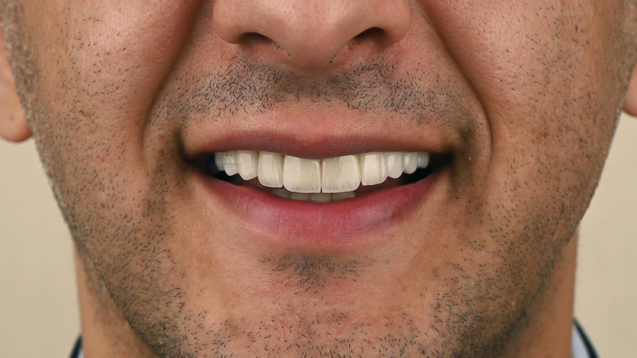 Complete Veneer Transformation Package 3