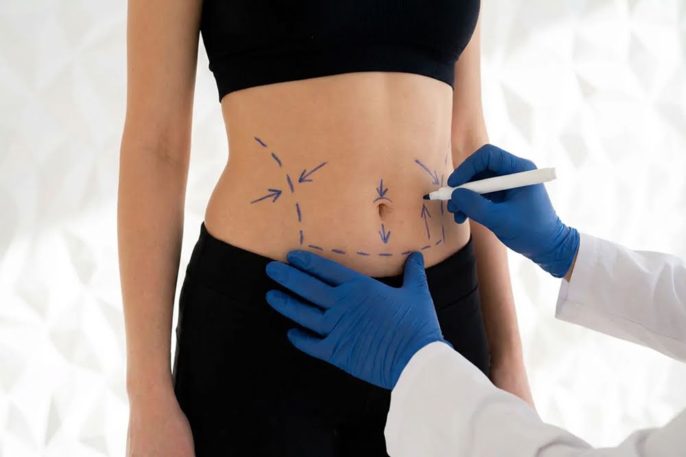 Endolift Silhouette – Body Lift & Definition